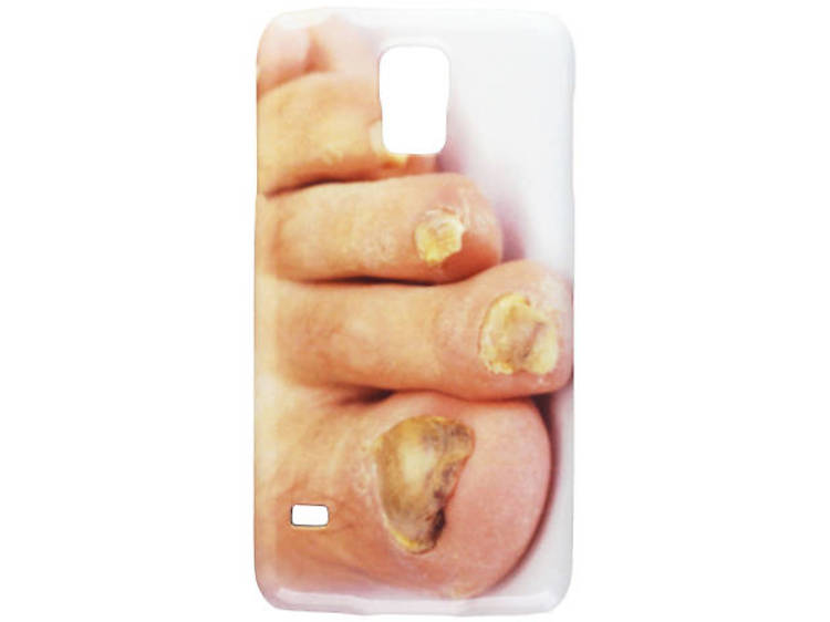 Toenail fungus phone case