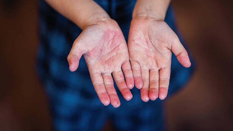 How to spot the symptoms of scarlet fever in your child