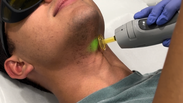 male laser treatment (BYou Laser Clinic)