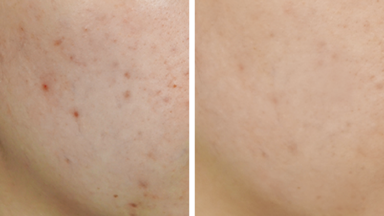The results after a TriLight Facial Therapy session
