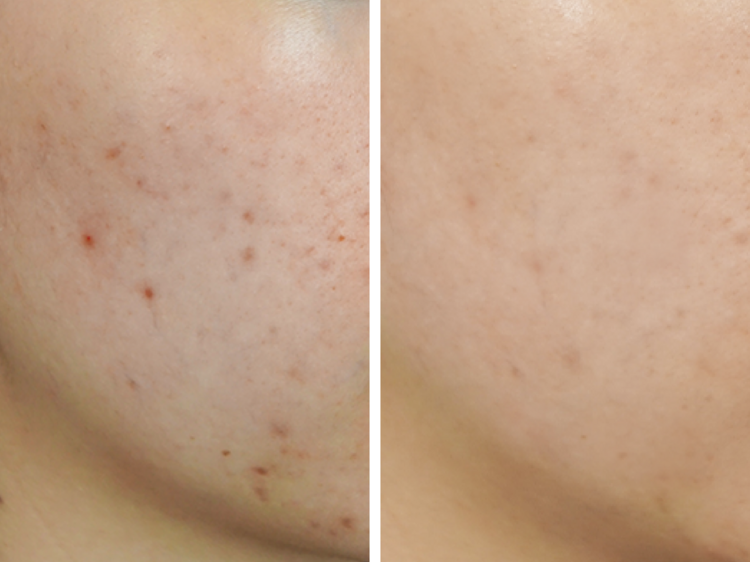 The results after a TriLight Facial Therapy session
