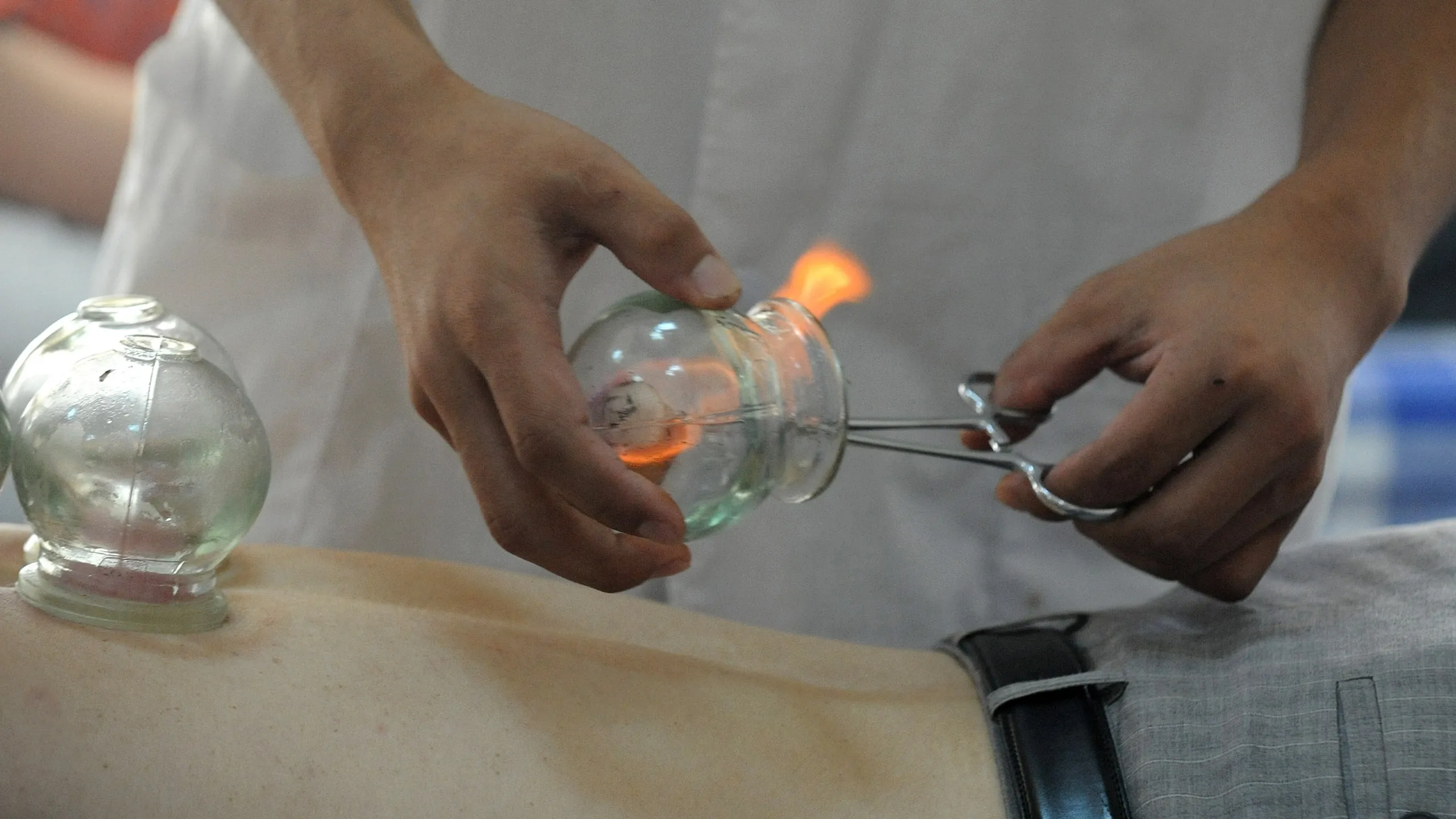 traditional chinese medicine moxibustion cupping